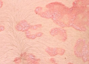 Psoriasis suffers have more to deal with than just irritated skin